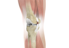 Complex Knee Injuries