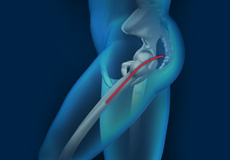 Posterior Total Hip Replacement